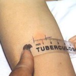tubercolosi-nuovi-casi