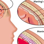 Meningite